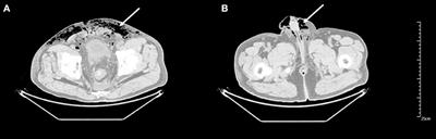 Case Report: Clostridial Gas Gangrene of Pelvic Wall After Laparoscopic Rectal Cancer Surgery Induced Fatal Sepsis